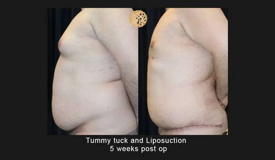 Tummy Tuck Before & After