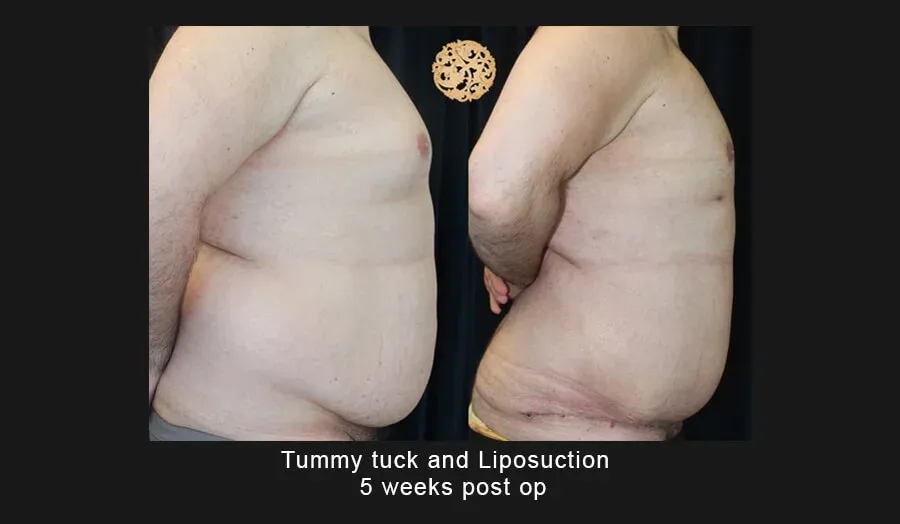 Tummy Tuck Before & After