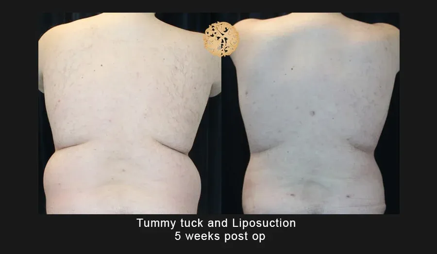 Tummy Tuck Before & After