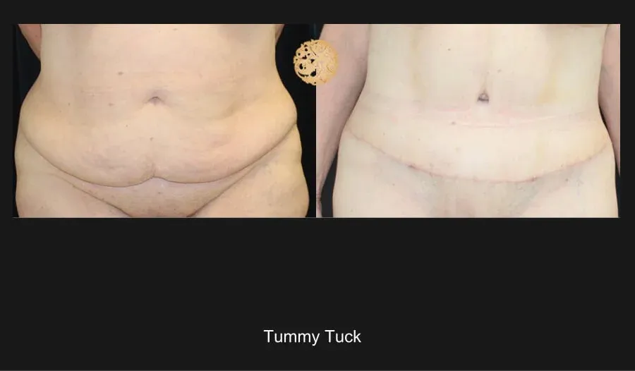 Tummy Tuck Before & After