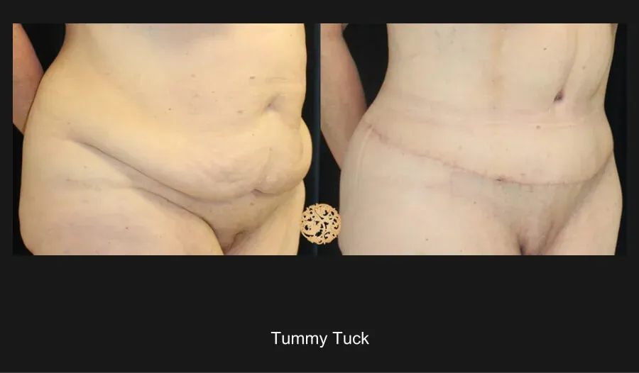 Tummy Tuck Before & After
