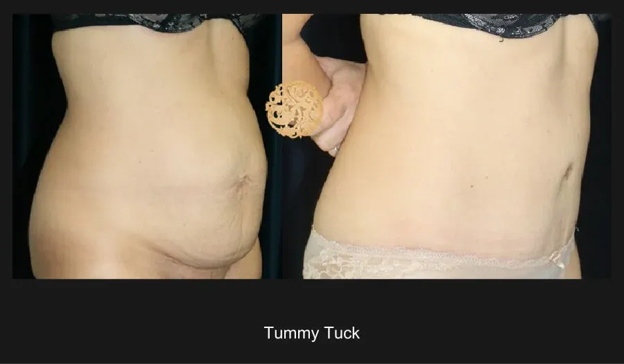 Tummy Tuck Before & After