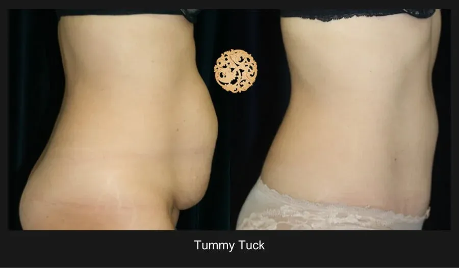 Tummy Tuck Before & After