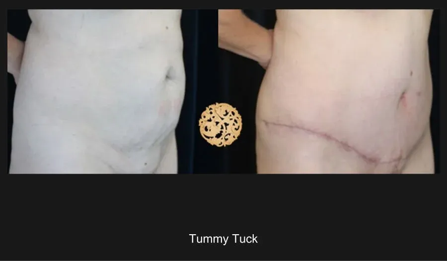 Tummy Tuck Before & After