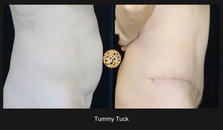 Tummy Tuck Before & After