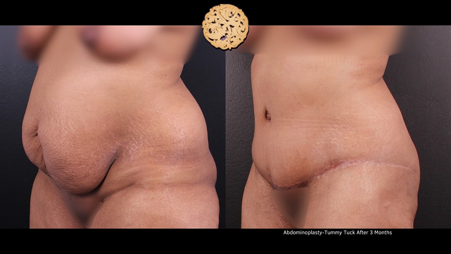 Tummy Tuck Before & After