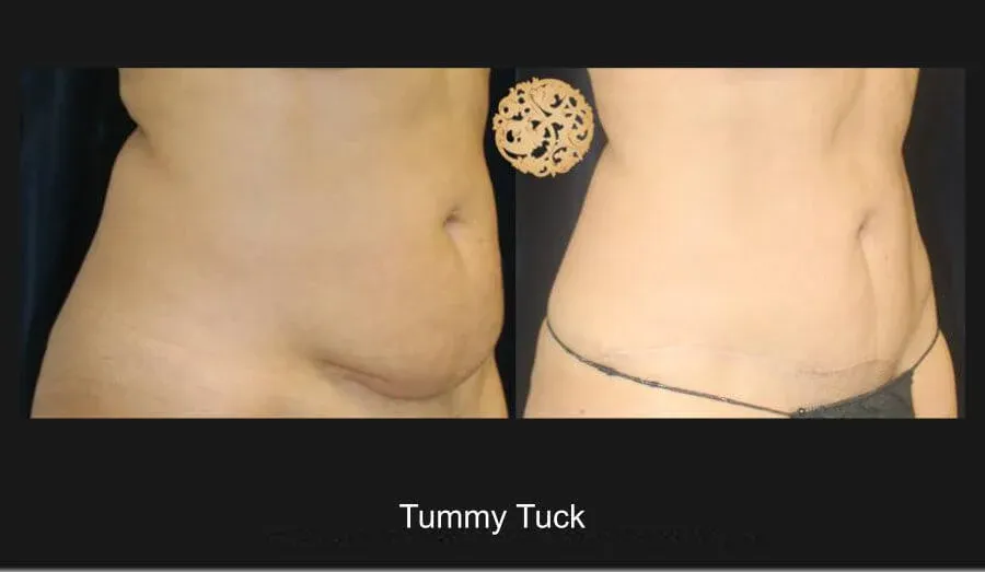 Tummy Tuck Before & After