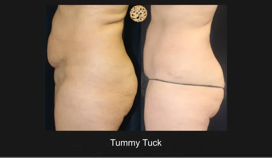 Tummy Tuck Before & After