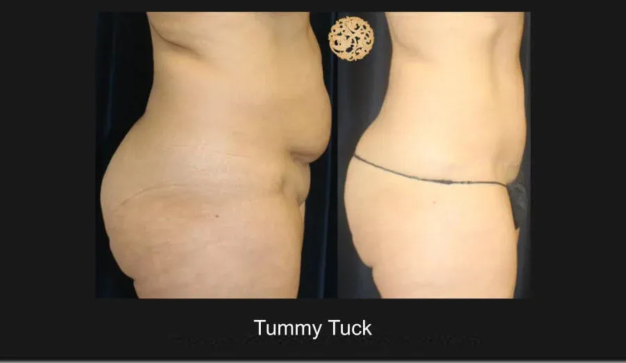 Tummy Tuck Before & After