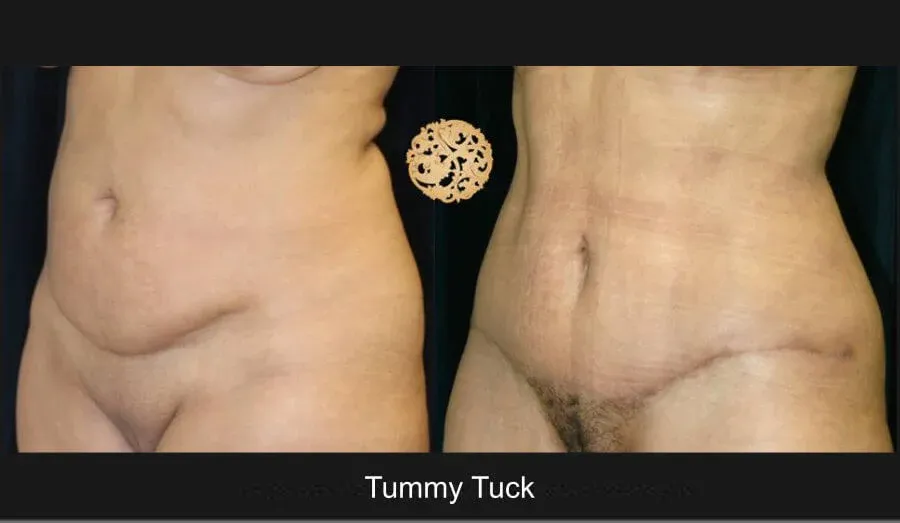 Tummy Tuck Before & After