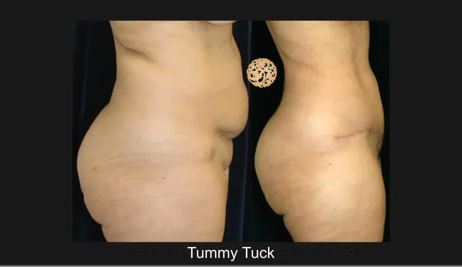 Tummy Tuck Before & After