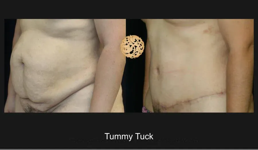 Tummy Tuck Before & After