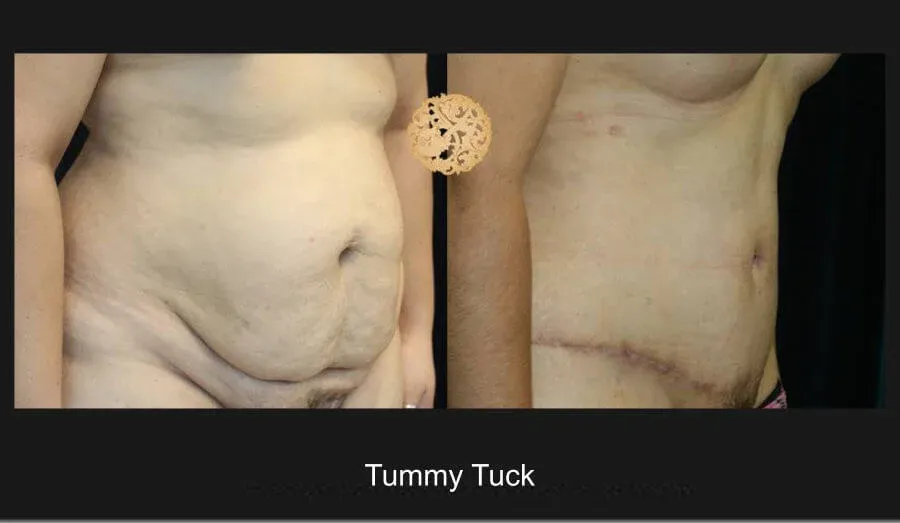 Tummy Tuck Before & After