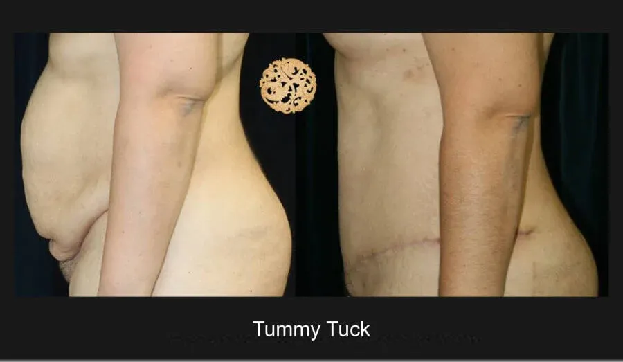 Tummy Tuck Before & After