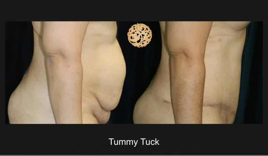 Tummy Tuck Before & After