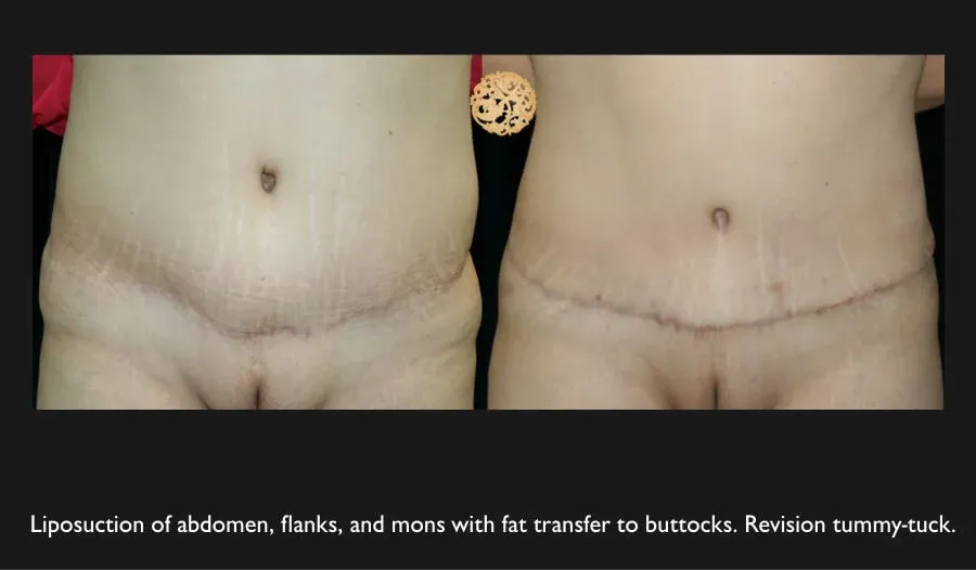 Tummy Tuck Before & After