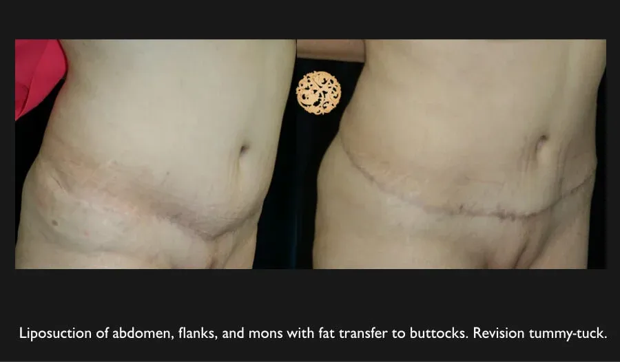 Tummy Tuck Before & After