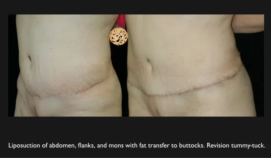 Tummy Tuck Before & After