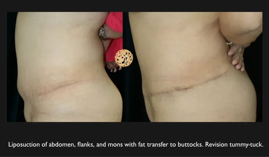 Tummy Tuck Before & After