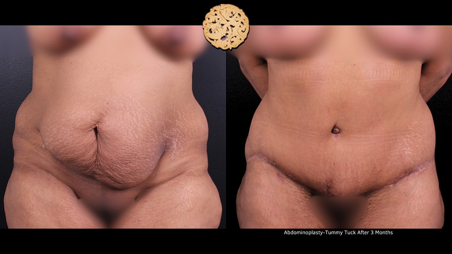 Tummy Tuck Before & After