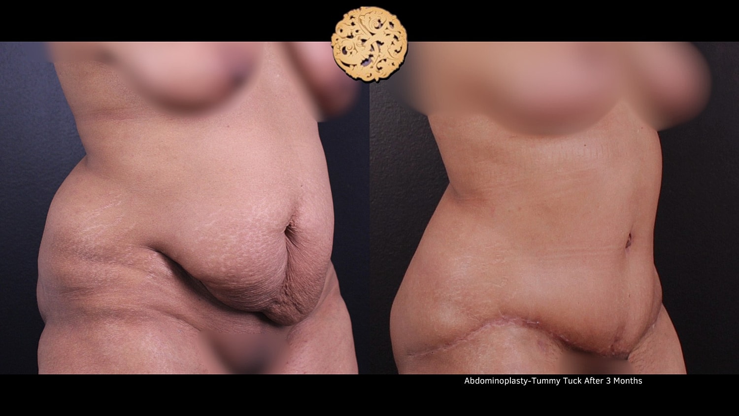 Tummy Tuck Before & After