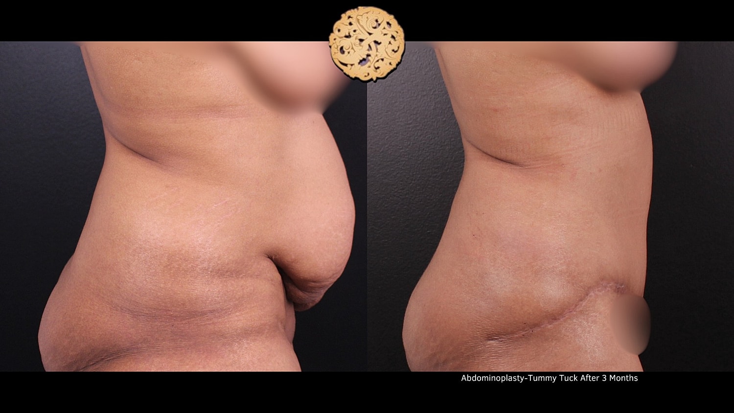 Tummy Tuck Before & After