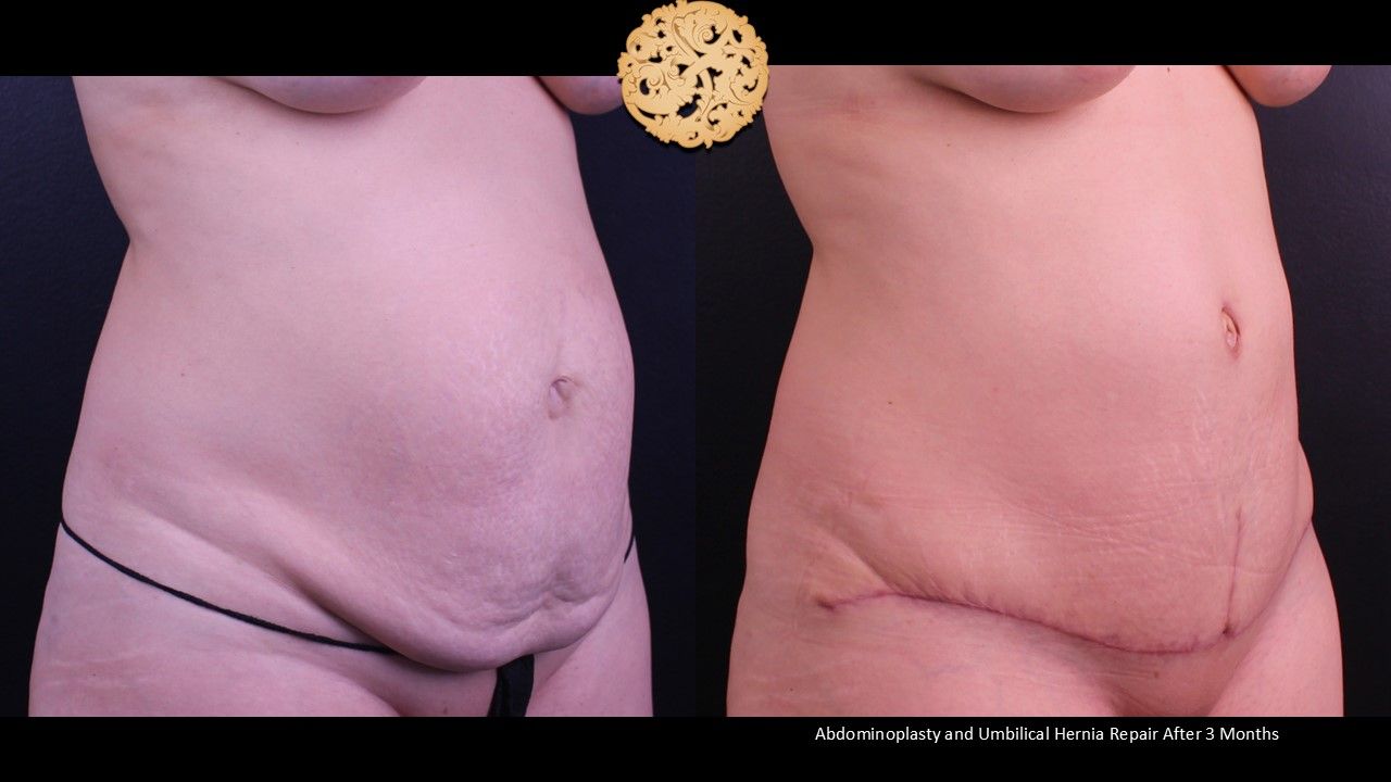 Tummy Tuck Before & After