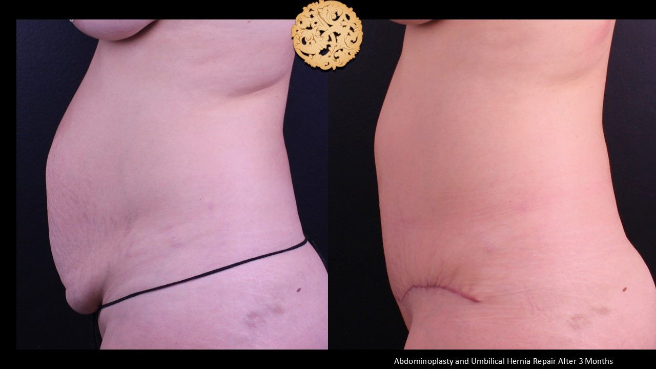 Tummy Tuck Before & After