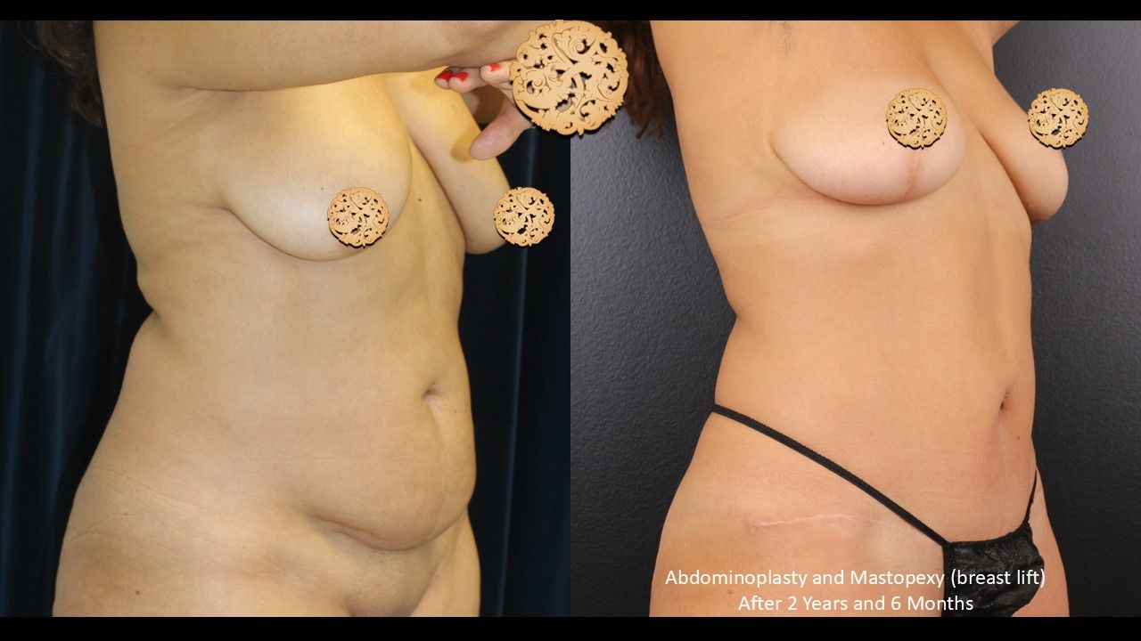 Tummy Tuck Before & After
