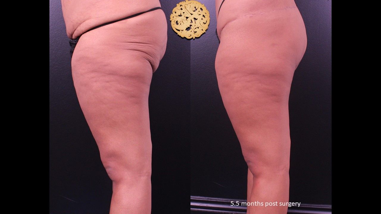 Thigh Lift Before & After