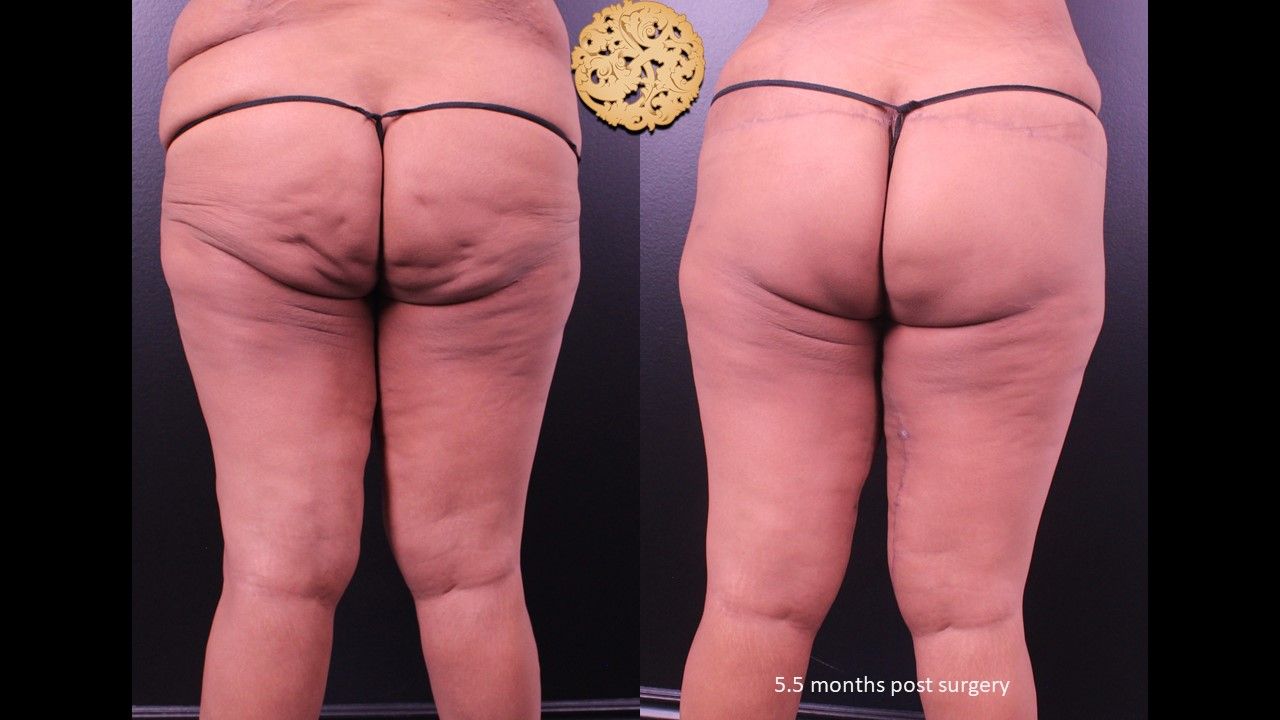 Thigh Lift Before & After