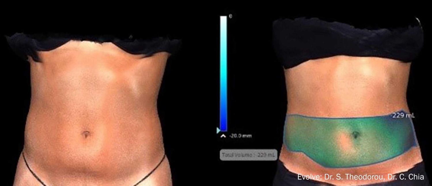 Evolve Trim Before & After