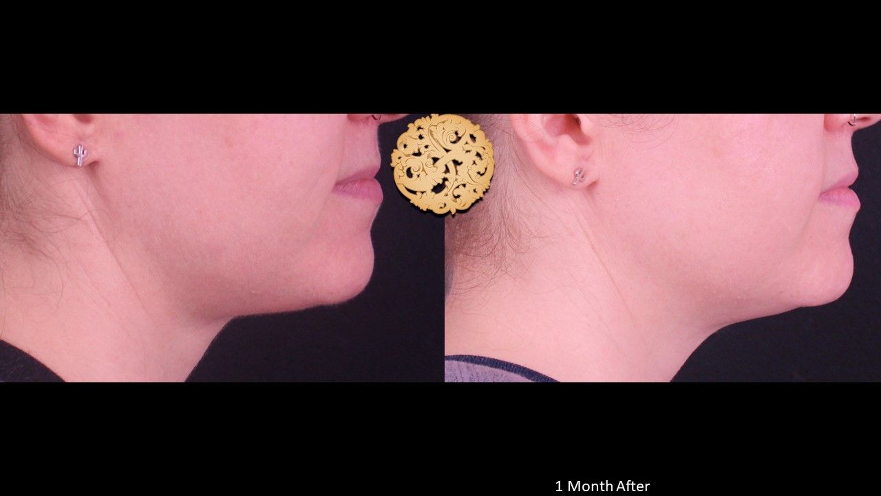 Accutite Before & After