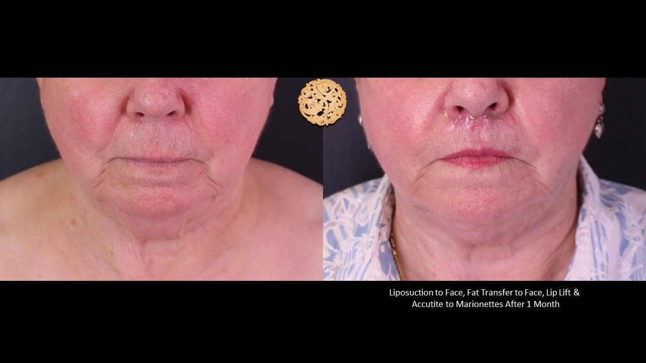 Accutite Before & After