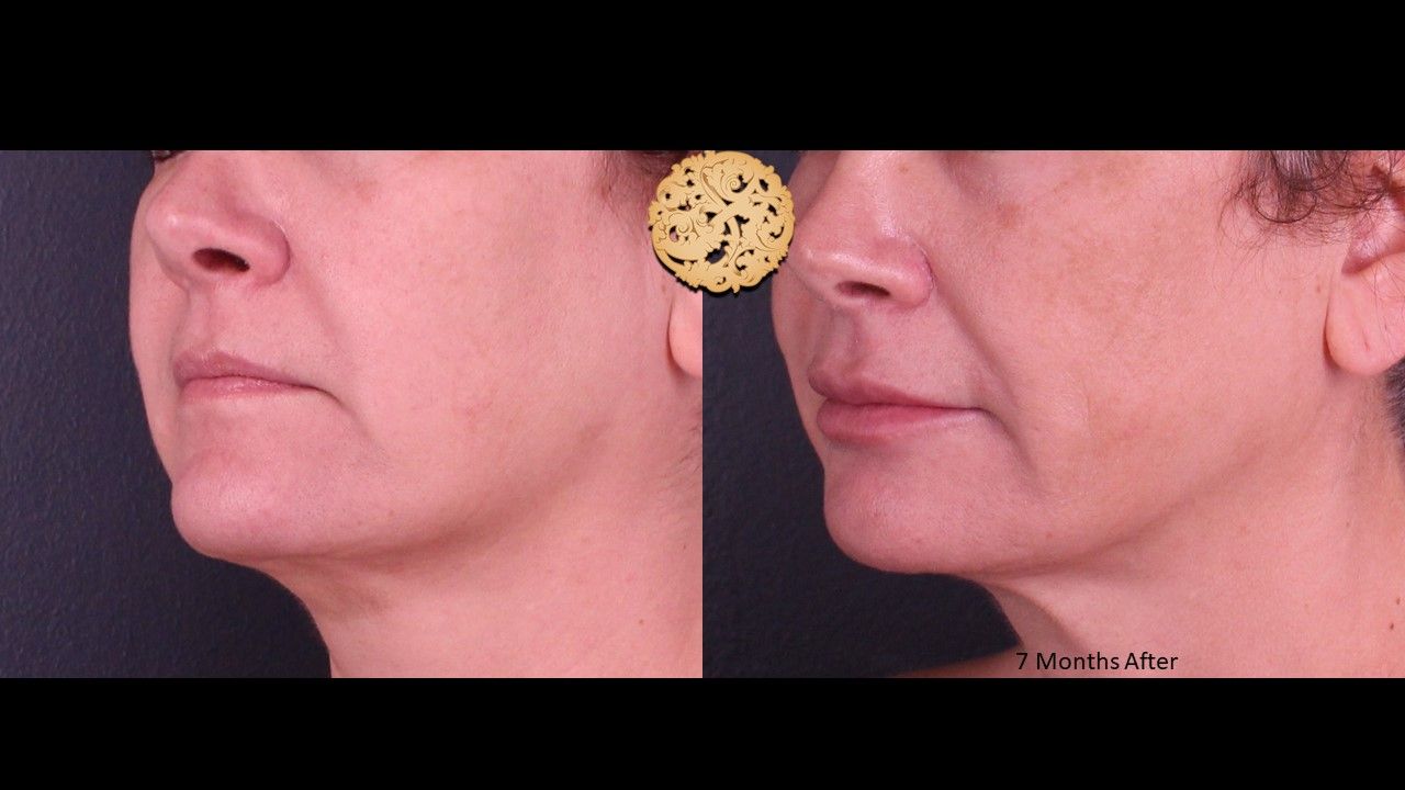 Accutite Before & After