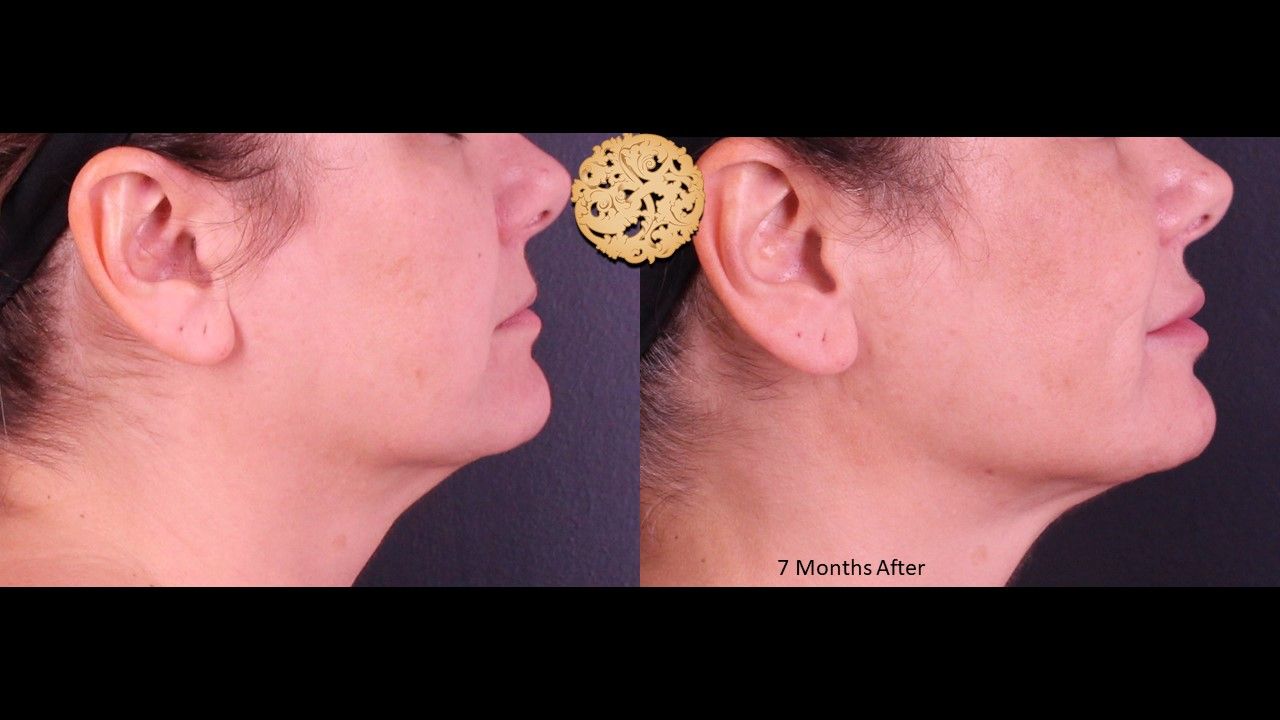 Accutite Before & After