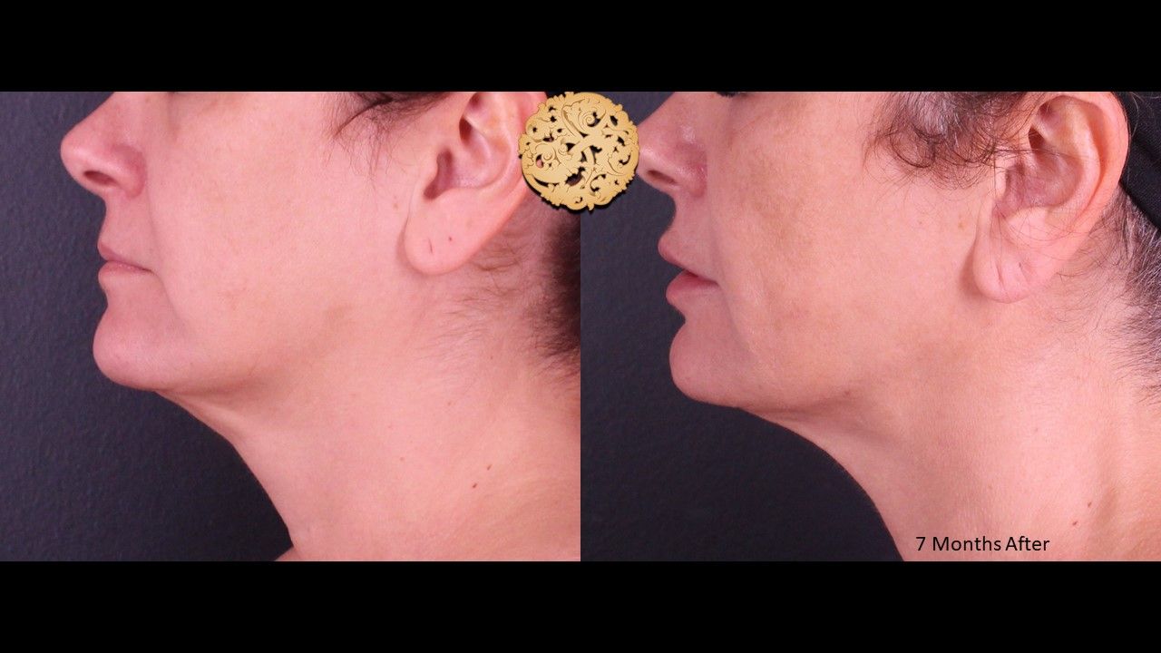 Accutite Before & After