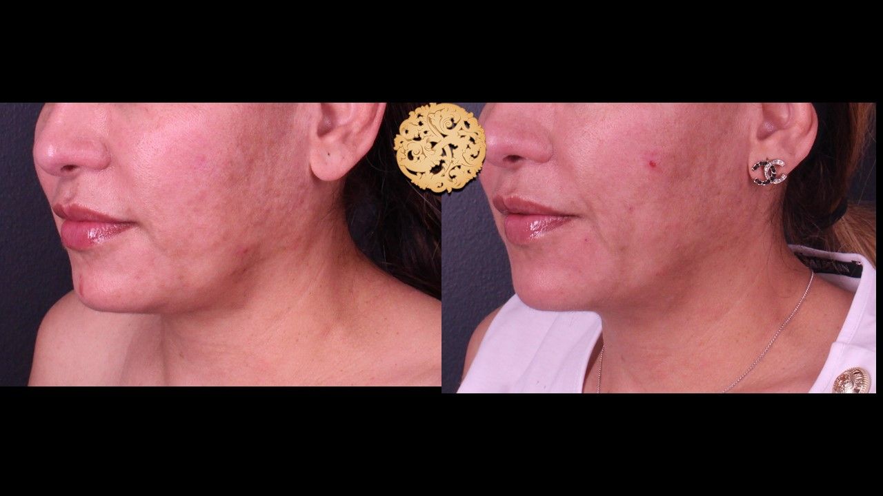 Accutite Before & After