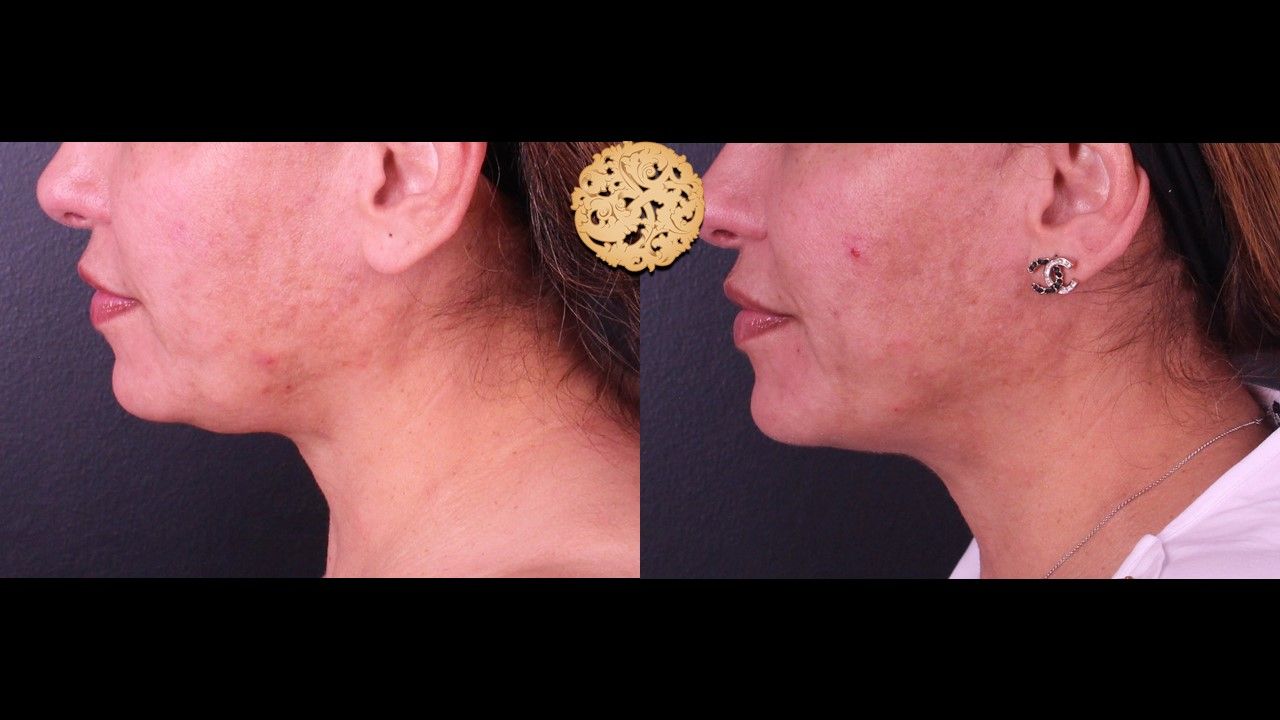 Accutite Before & After