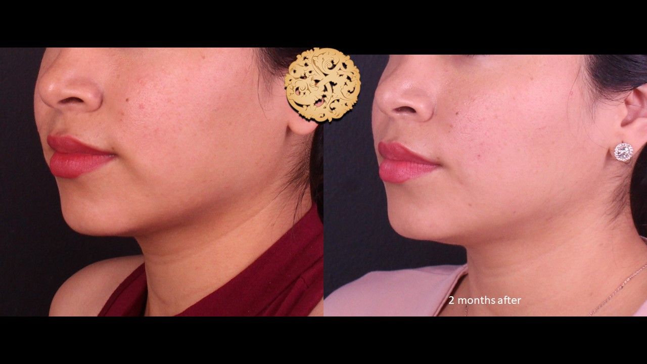 Accutite Before & After