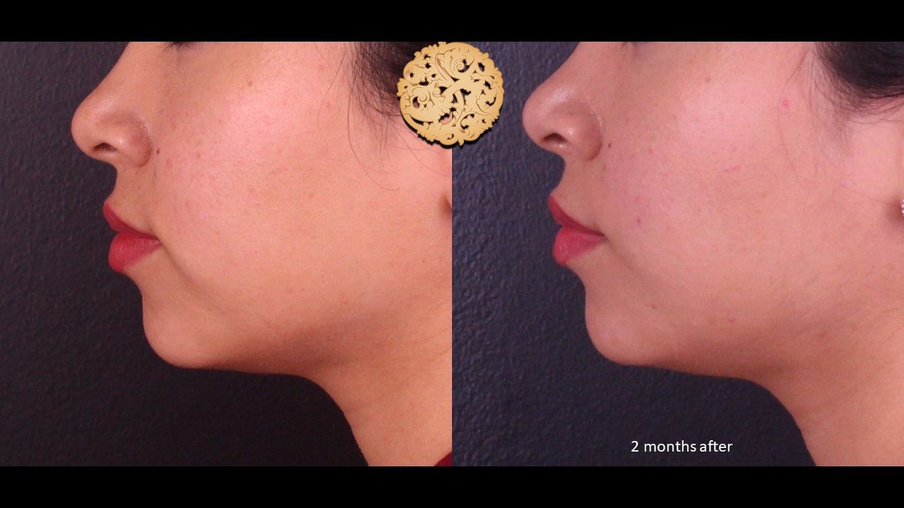 Accutite Before & After