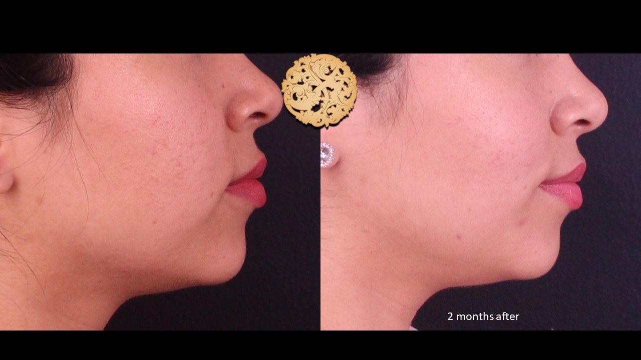 Accutite Before & After