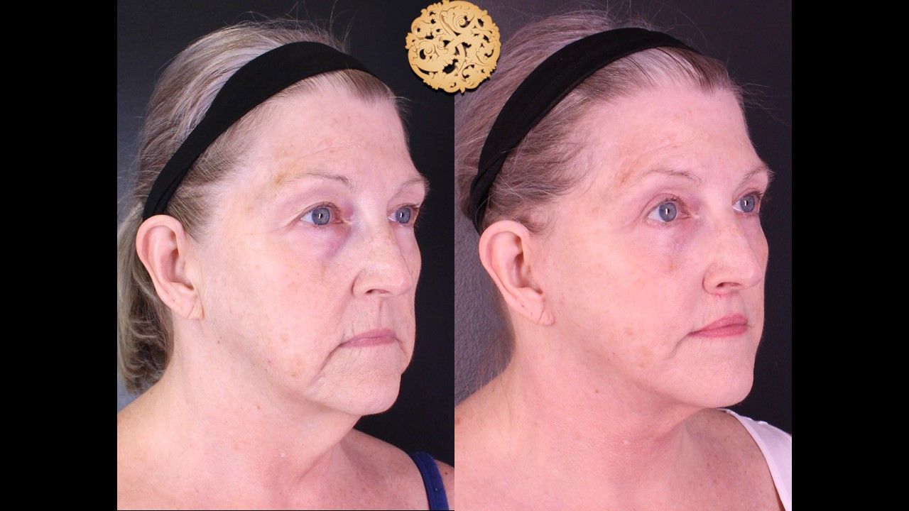Accutite Before & After