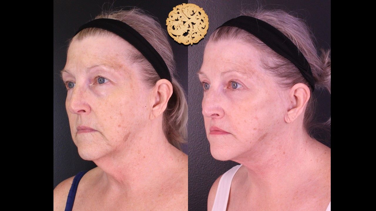 Accutite Before & After