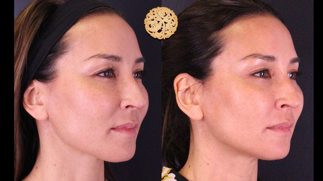 Accutite Before & After