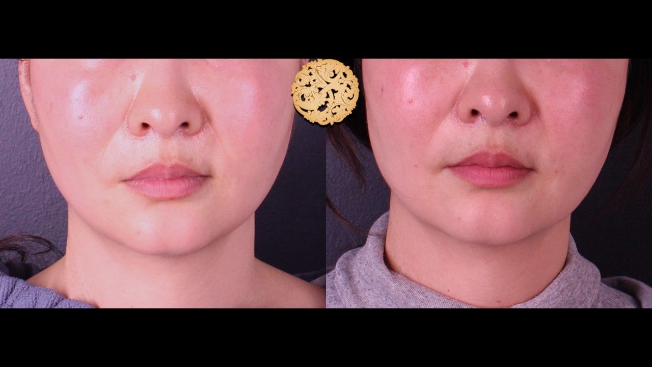 Accutite Before & After