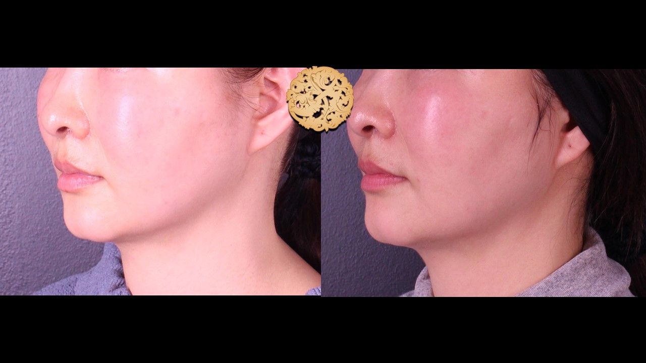Accutite Before & After