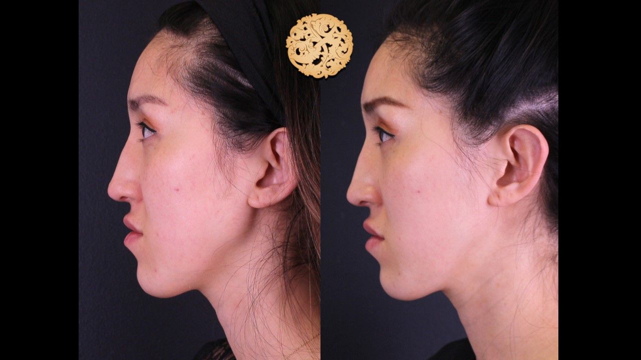 Vivace Before & After