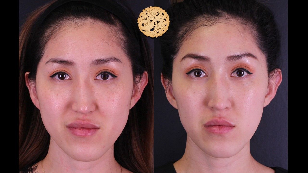 Vivace Before & After