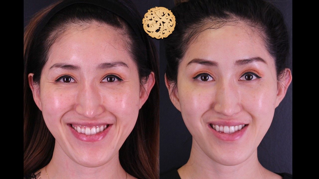 Vivace Before & After